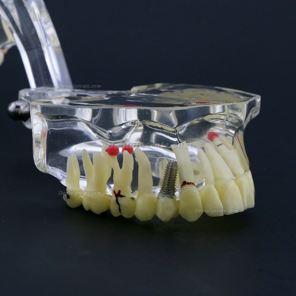 Neue Dental Teach-Studie Allgemeine Erwachsenenpathologie Typodont Z&auml;hne Modell # 4001